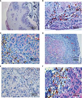 Neutrophils Promote Tumor Progression in Oral Squamous Cell Carcinoma by Regulating EMT and JAK2/STAT3 Signaling Through Chemerin